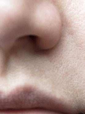 7 Powerful Ingredients For Hyperpigmentation Treatment