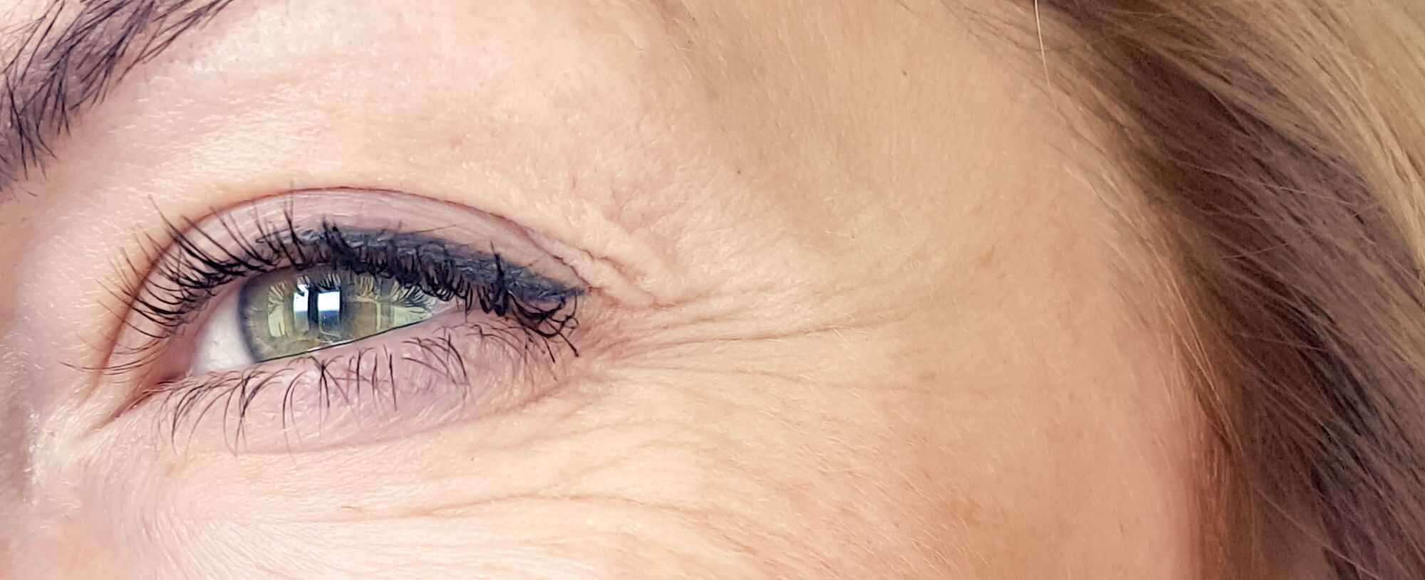 Help Ive Got Vertical Lines Cropping Up Under My Eyes