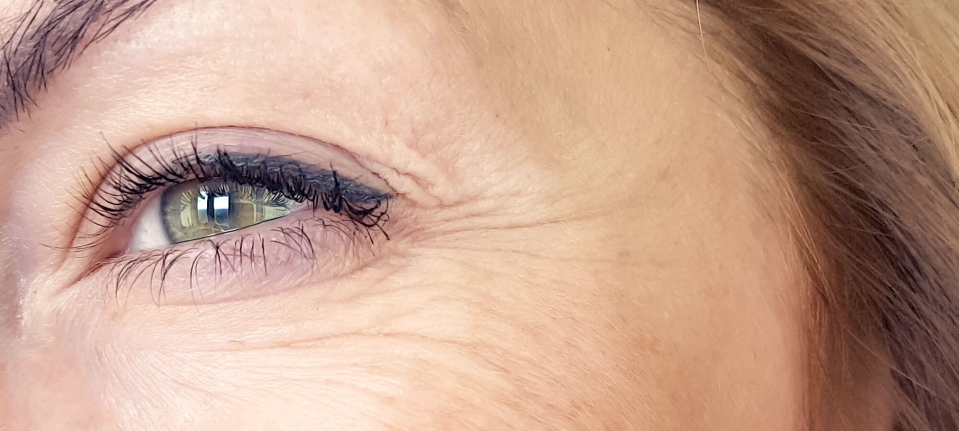 I Have Got Vertical Lines Cropping Up Under My Eyes Article