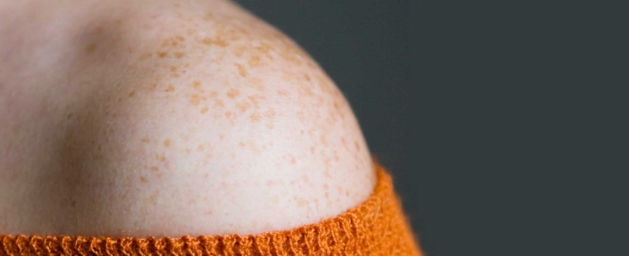 What On Earth Is Keratosis Pilaris