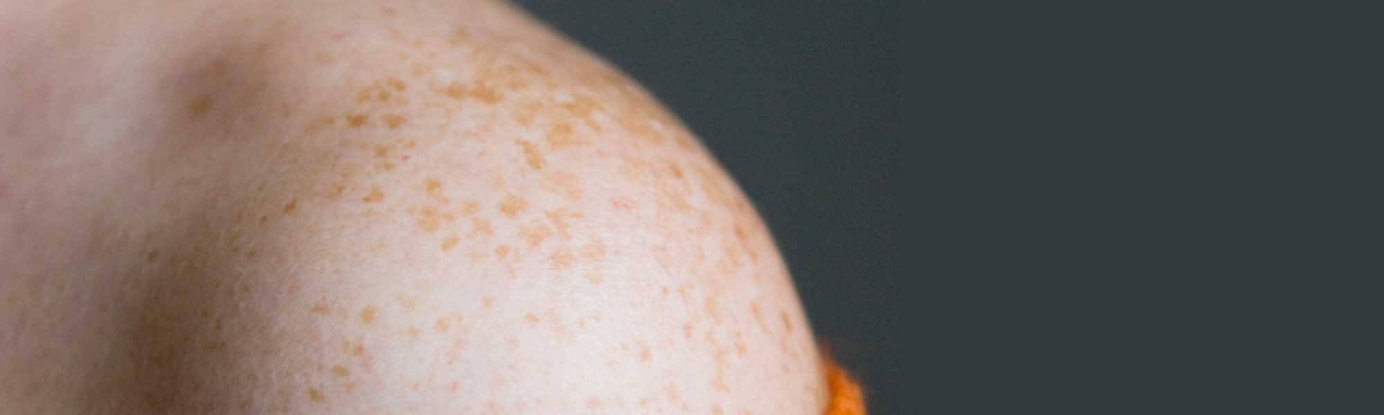 What On Earth Is Keratosis Pilaris