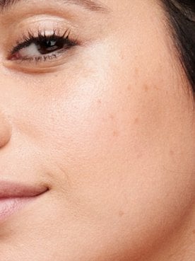 What Are Dark Spots