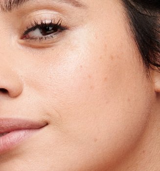 What Are Dark Spots
